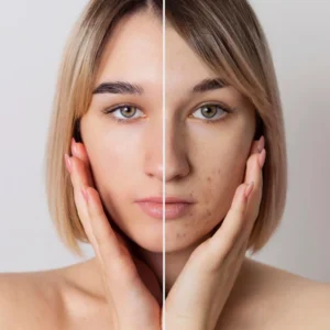 Chemical Peels Course (CPD Accredited)