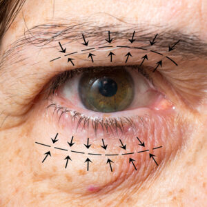 Periorbital Area Course (CPD Accredited)